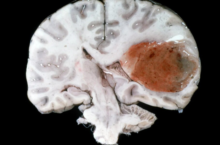 سرطان تومور مغزی