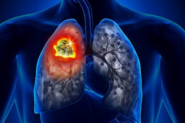 آزمایش و عملکرد موفق قرص جدید سرطان ریه