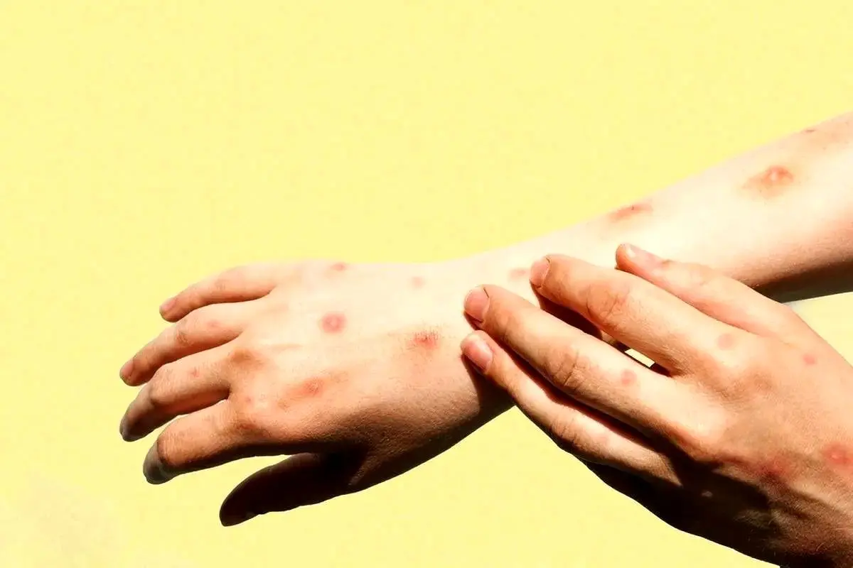 زنگ خطر شیوع تب دنگی در این منطقه به صدا در آمد