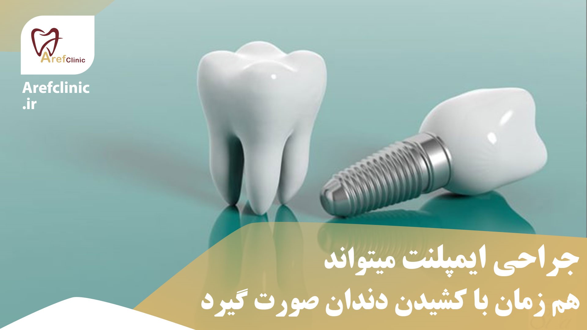 مرکز تخصصی ایمپلنت در کرج