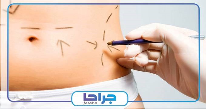 جراح لیپوماتیک را چگونه بشناسیم؟