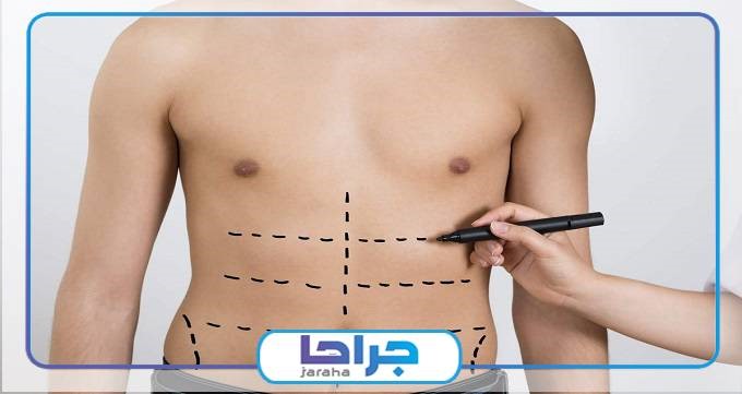 لیپوماتیک بهتر است یا لیپوساکشن؟