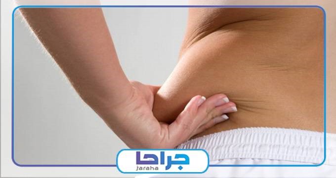 چه کسانی کاندیدای مناسب برای لیپوماتیک هستند؟